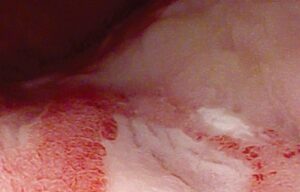 Askin Pentax Snímka hrubého čreva s ulceróznou kolitídou v HD+ vysokom rozlíšení 